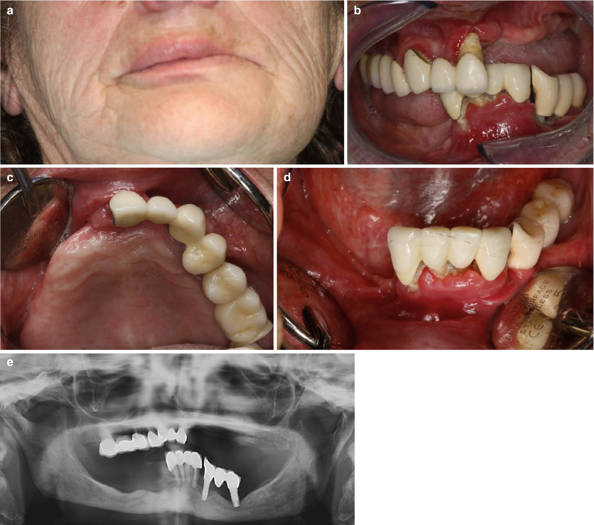 Immediate Loading In All On Four Springerlink
