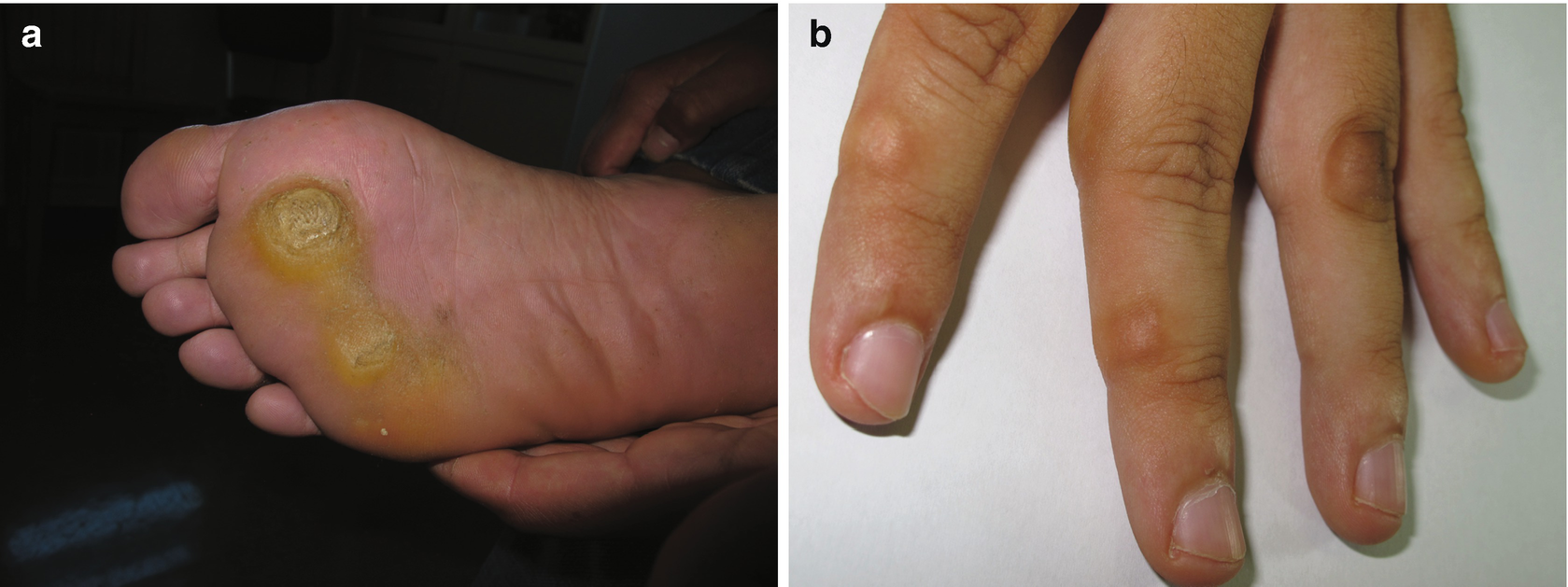 images Wrist Bilateral Piezogenic Papules Of The Heel dermatological injuries springerlink