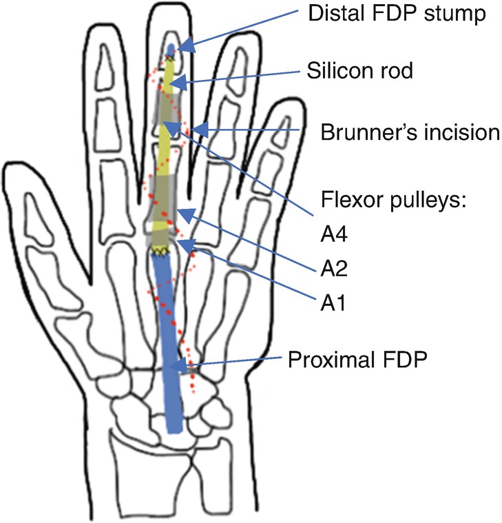 brunner type incision