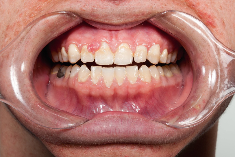 Oral Signs Of Genetic Disease Springerlink