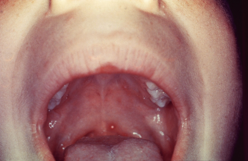 Oral Signs of Viral Disease | SpringerLink Oral Signs of Viral Disease | SpringerLink