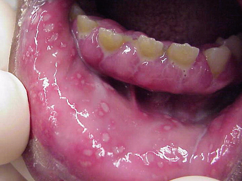 Oral Signs of Viral Disease | SpringerLink Oral Signs of Viral Disease | SpringerLink