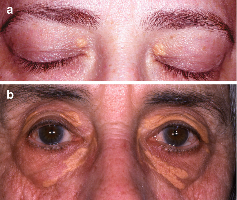 Eyelid Lesions Springerlink