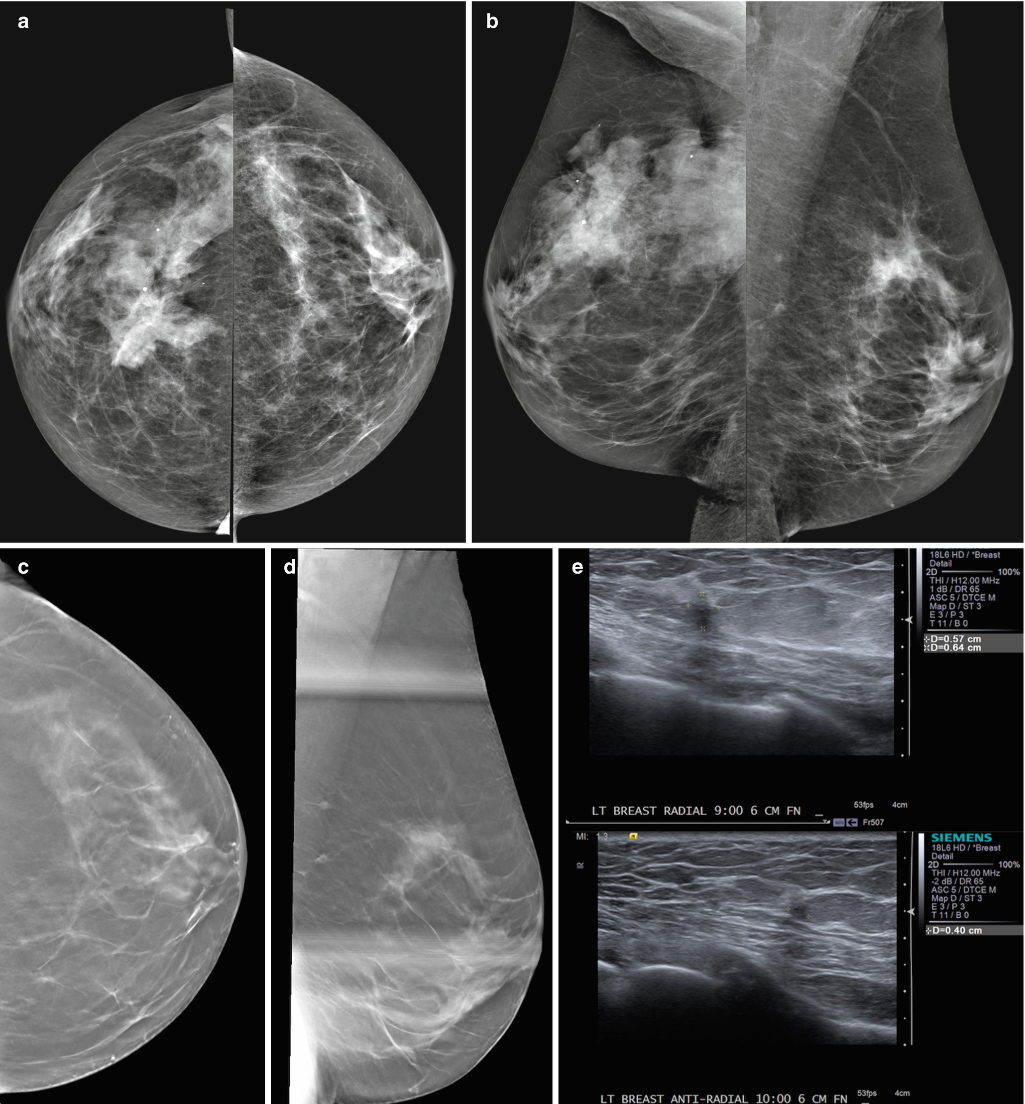 Diagnosis and Staging of Breast Cancer: When and How to Use Mammography,  Tomosynthesis, Ultrasound, Contrast-Enhanced Mammography, and Magnetic  Resonance Imaging | SpringerLink