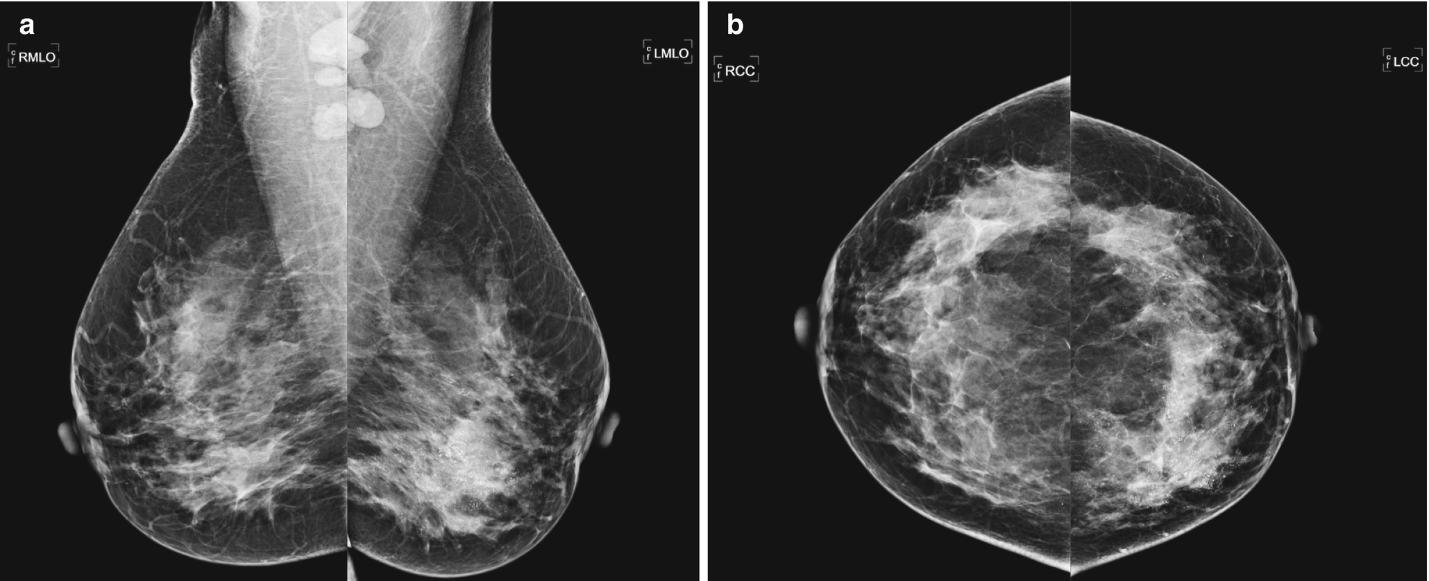 Mammogram atypical mass large breasts Diagnosis And Staging Of Breast Cancer When And How To Use Mammography Tomosynthesis Ultrasound Contrast Enhanced Mammography And Magnetic Resonance Imaging Springerlink