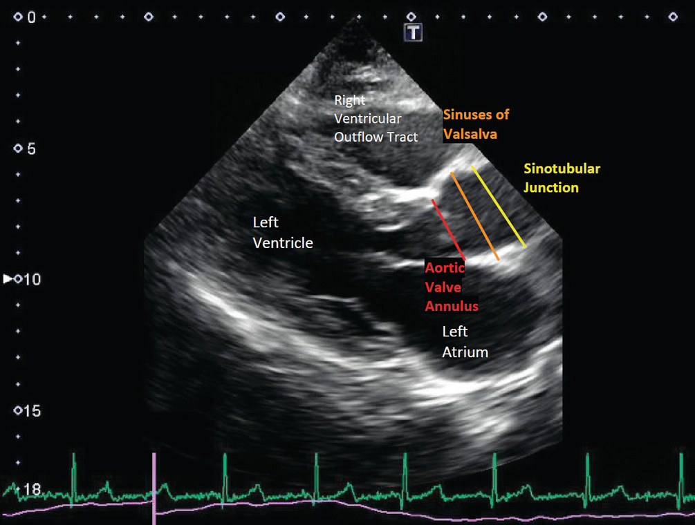 Imaging Of The Aorta Springerlink Imaging Of The Aorta Springerlink