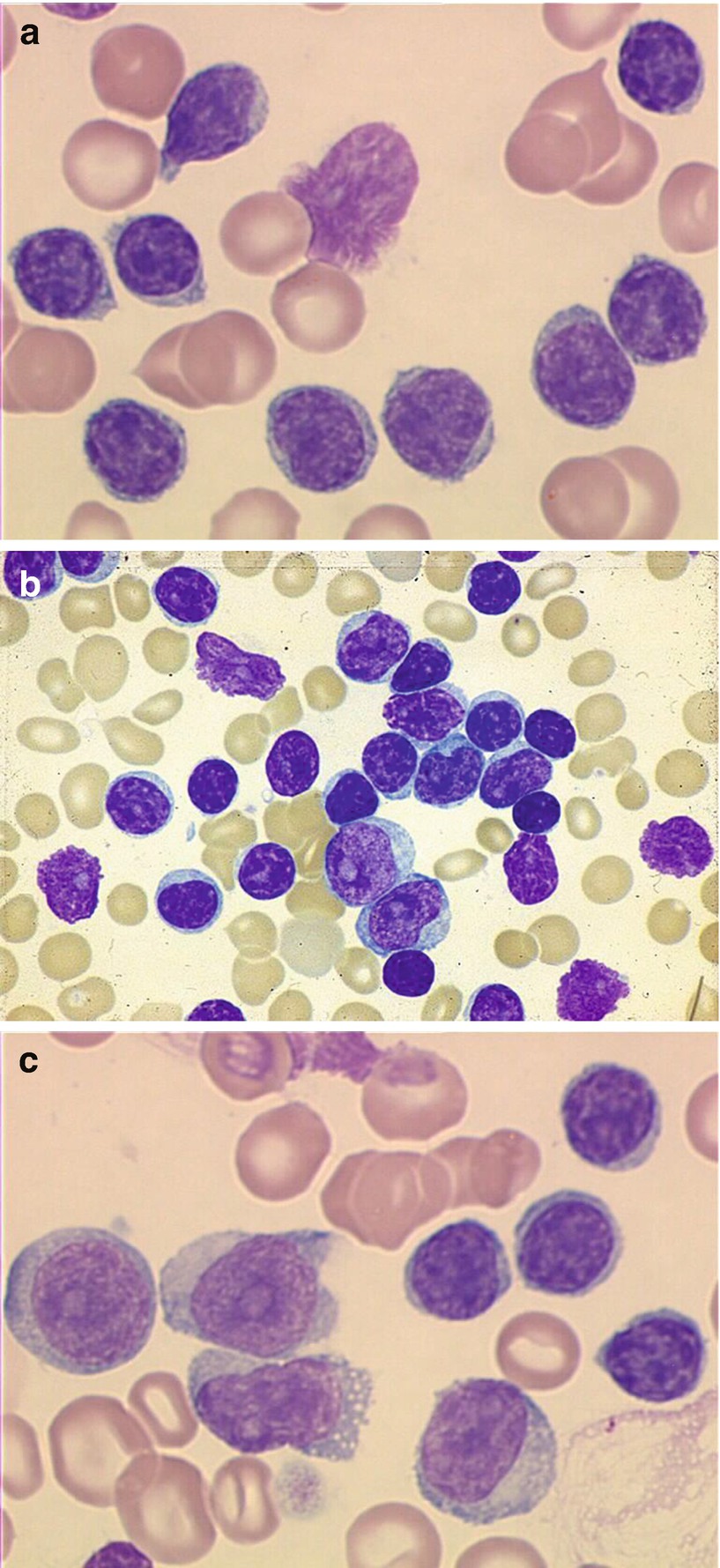 The Clinical Presentation Of Cll Springerlink