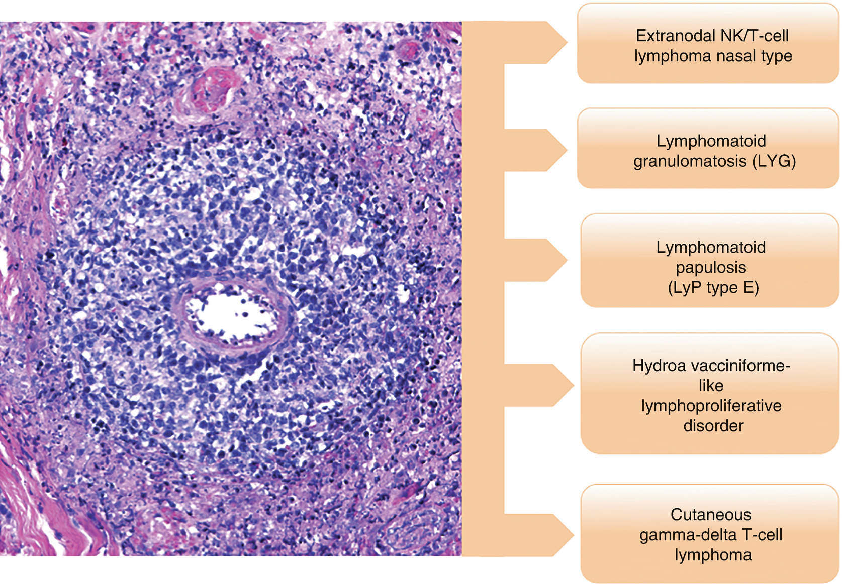 Primary Cutaneous Cd30 Lymphoproliferative Disorders Lymphomatoid Papulosis Springerlink