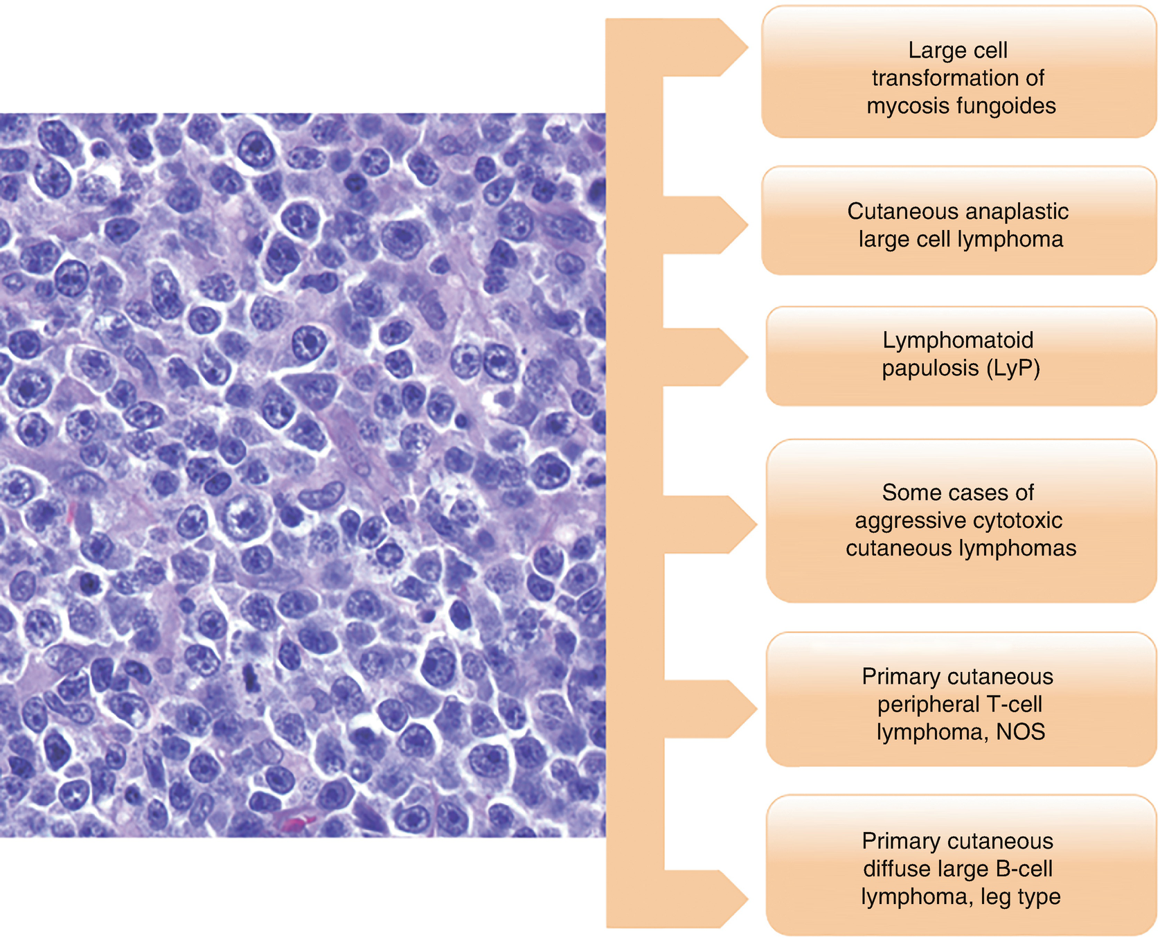 Primary Cutaneous Cd30 Lymphoproliferative Disorders Lymphomatoid Papulosis Springerlink