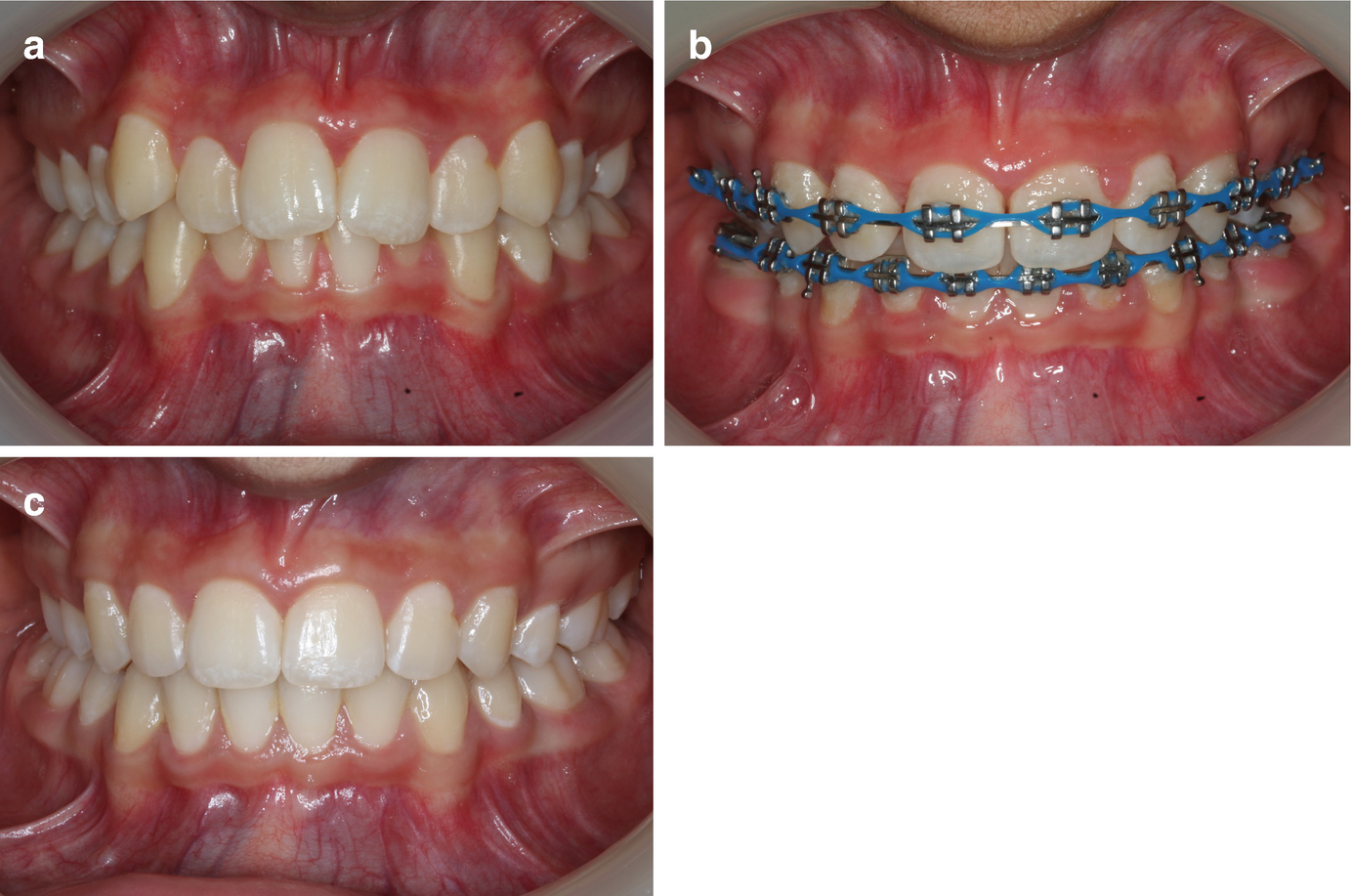 Orthodontic Management Of The Dentition With The Preadjusted Appliance Online
