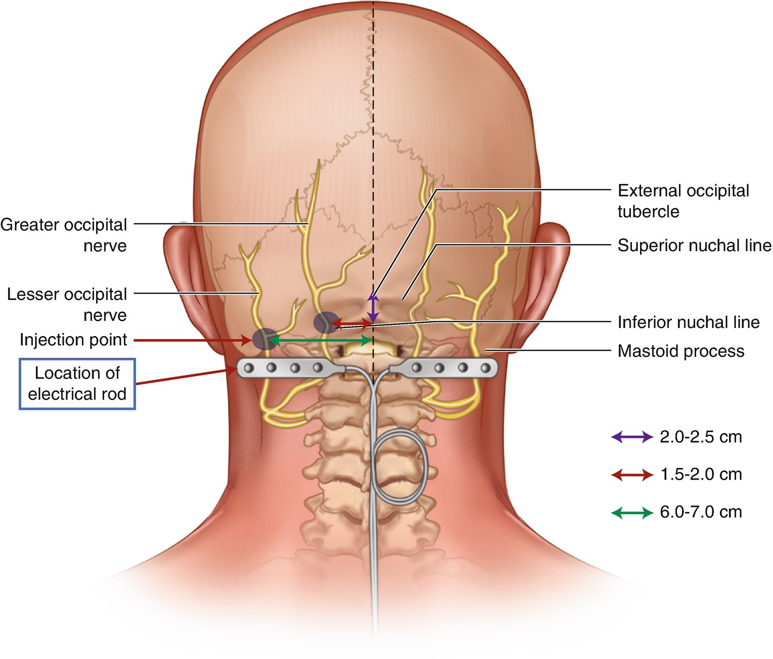 Occipital Nerve Stimulation Springerlink