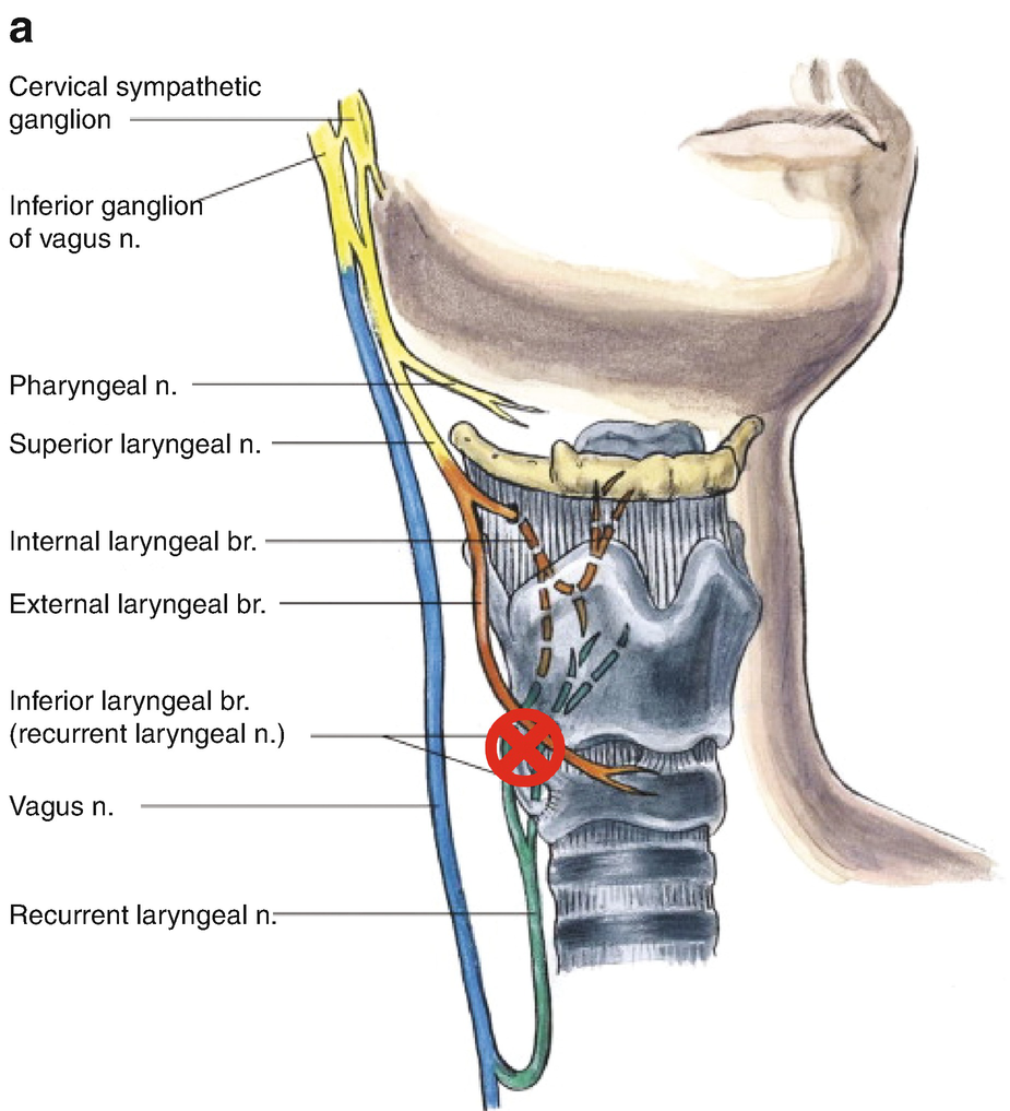 Lma Morbidity A Case Of Unilateral Recurrent Laryngeal Nerve Palsy Springerlink