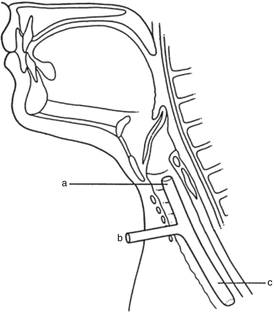 Pseudocholinesterase Deficiency In A Patient With Subglottic