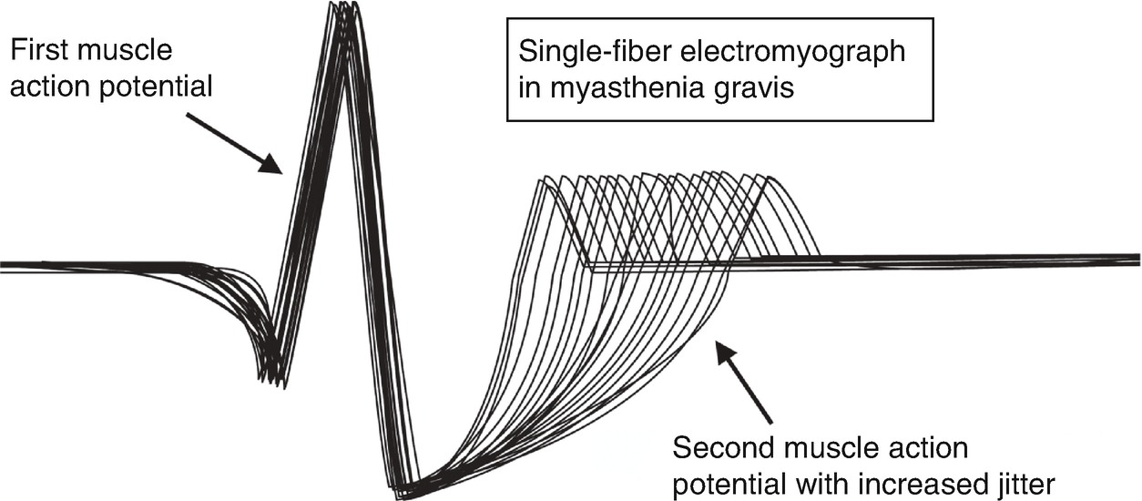 Myasthenia Gravis Springerlink