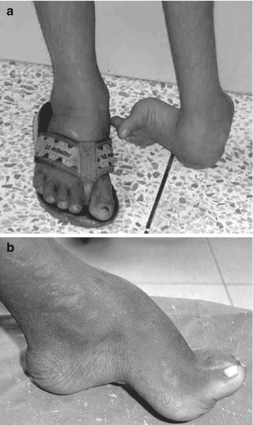 Algorithm For Neglected Clubfoot And Residual Deformities Following Treatment Springerlink