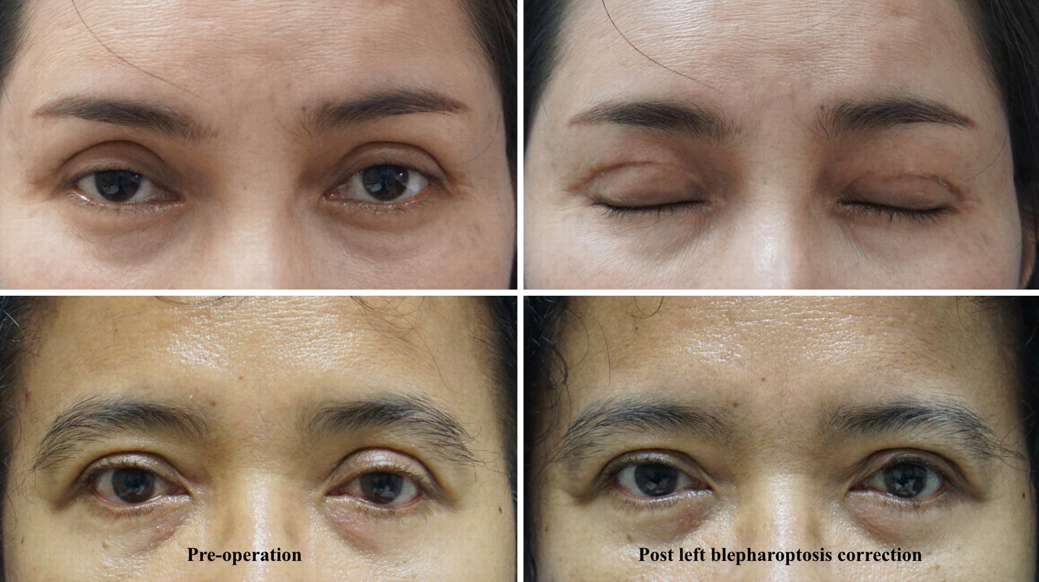 Complications Of Asian Upper Blepharoplasty And Their Solutions Springerlink