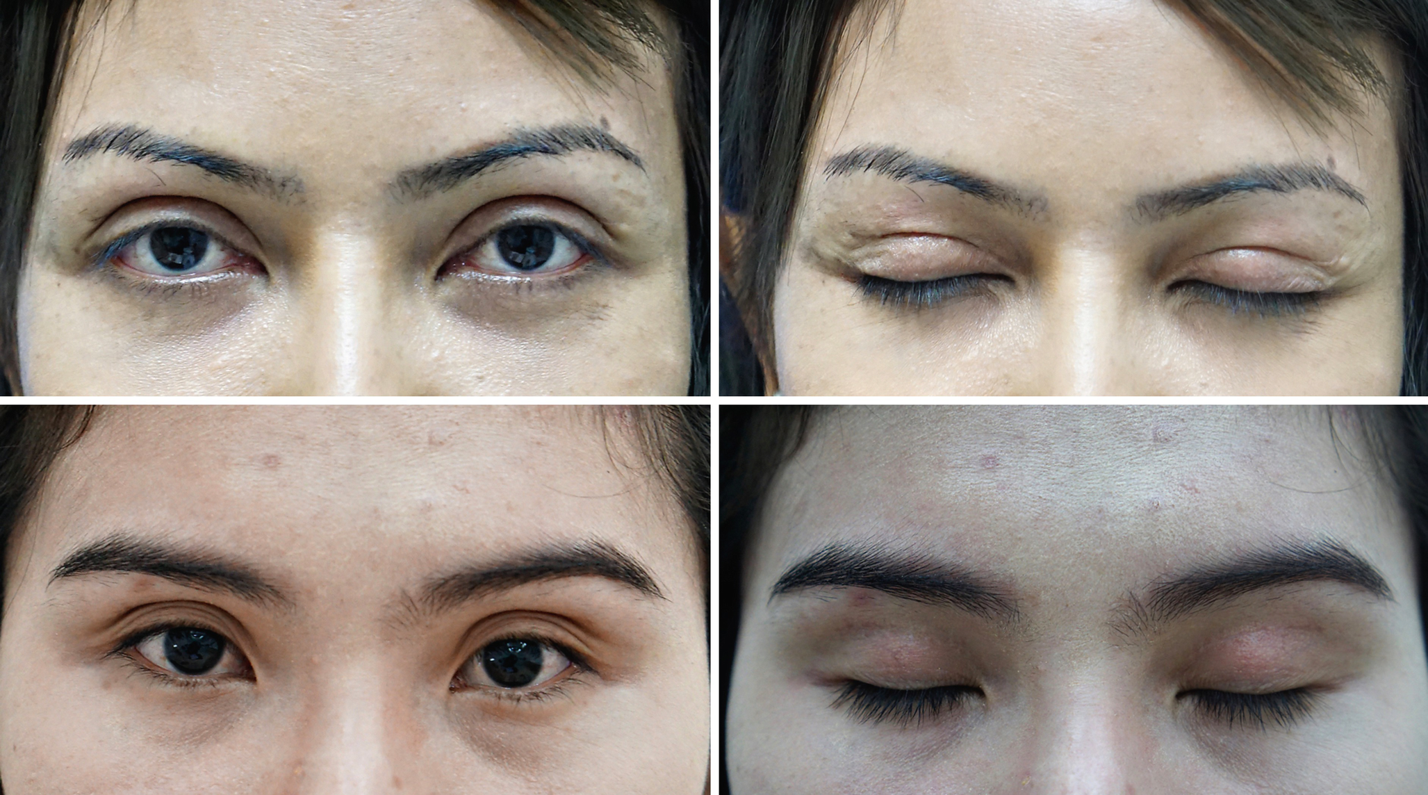 asian upper eyelid surgery