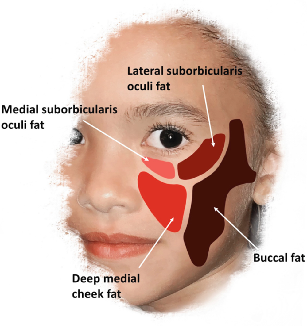 Evaluation Of The Facelift Patient Springerlink