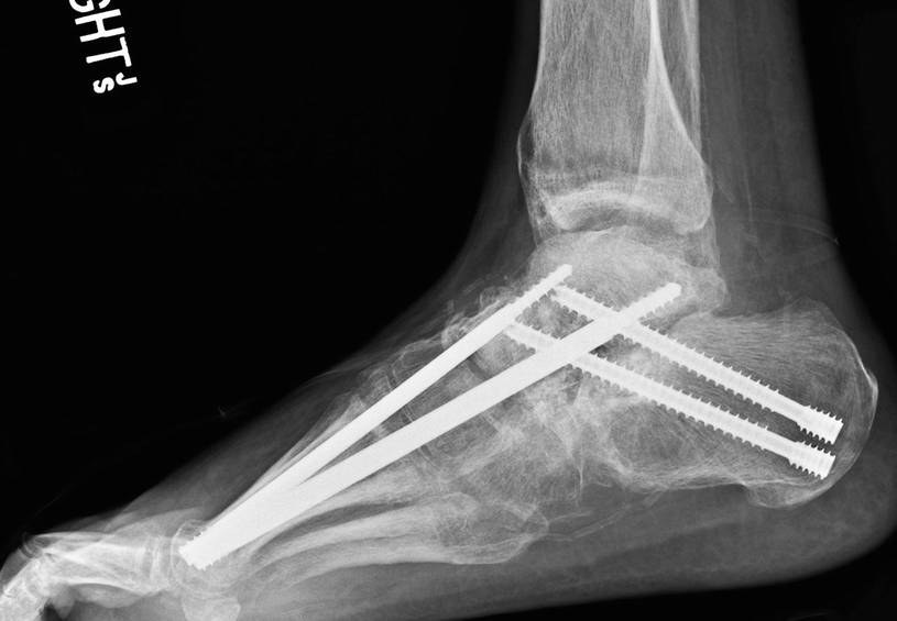 Hindfoot and Ankle Charcot Reconstruction | SpringerLink