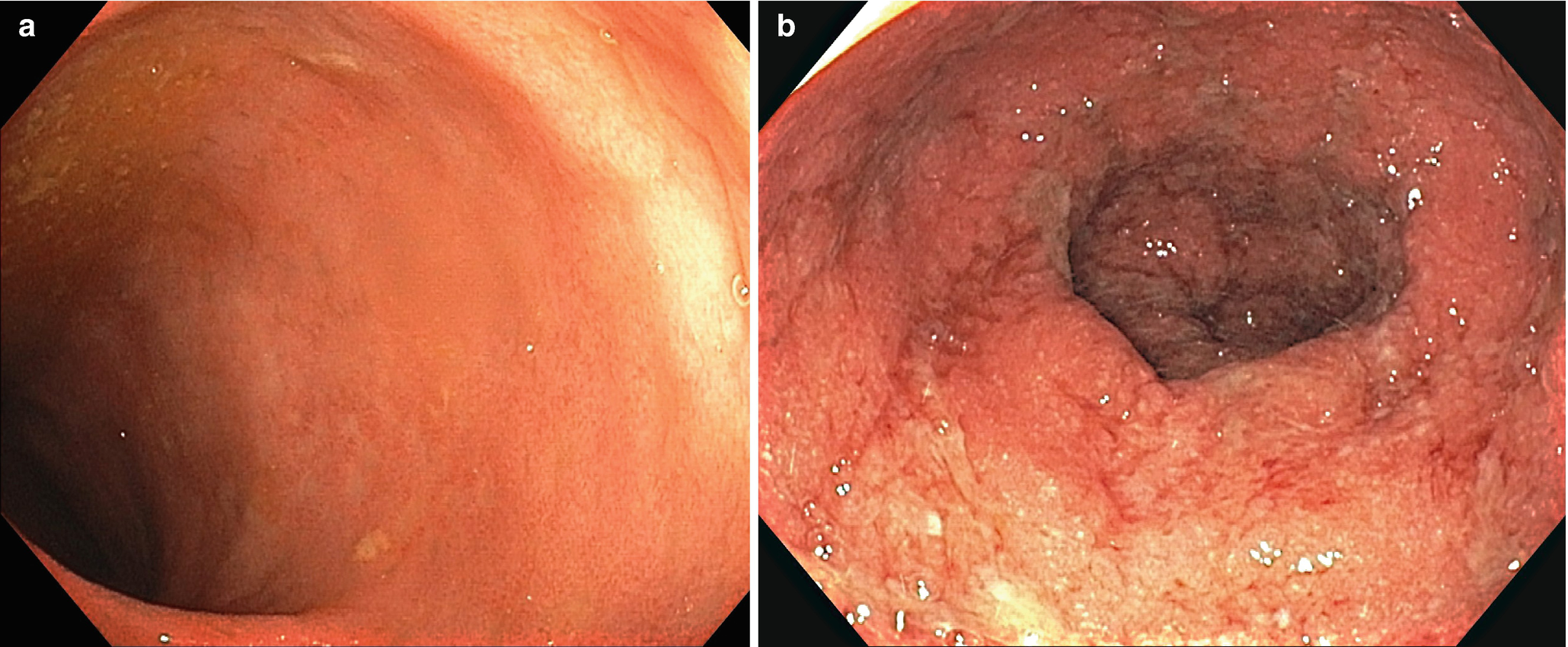 Inflammatory Bowel Disease Springerlink Inflammatory Bowel Disease Springerlink