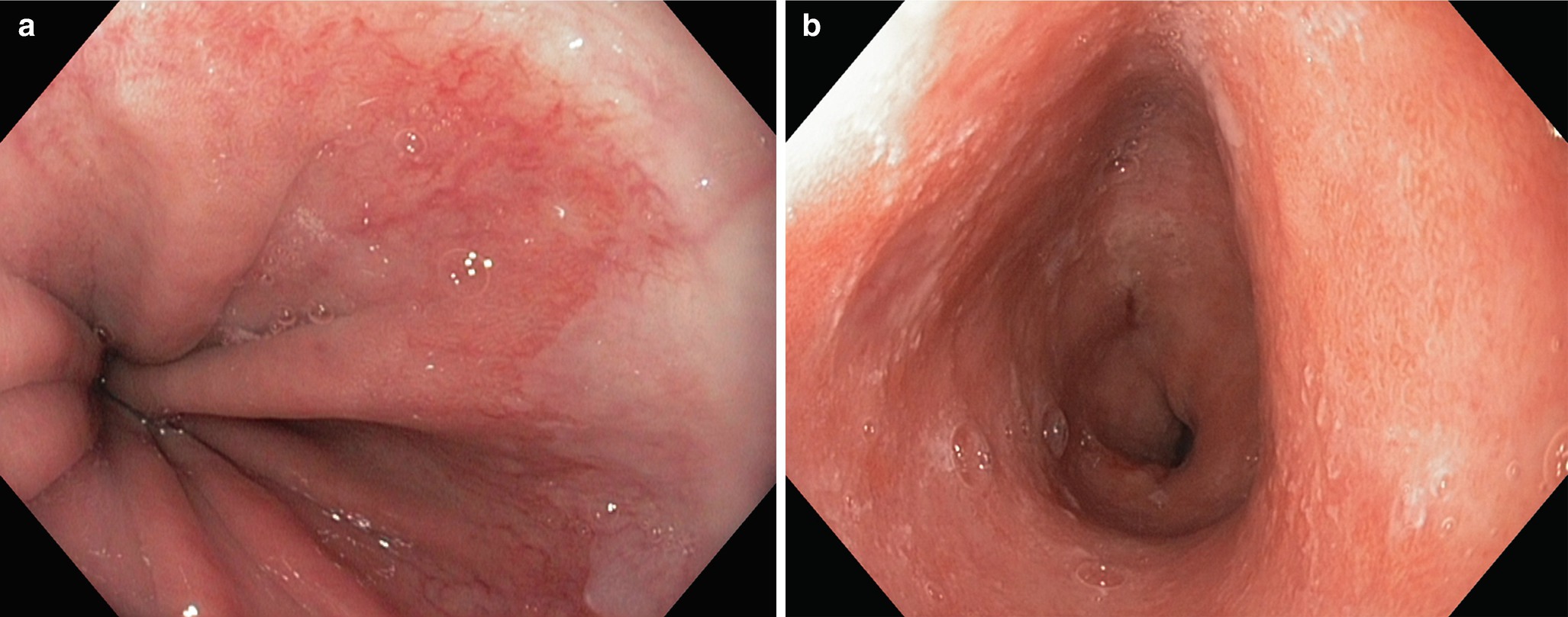 Reflux Esophagitis And Barrett Esophagus Springerlink