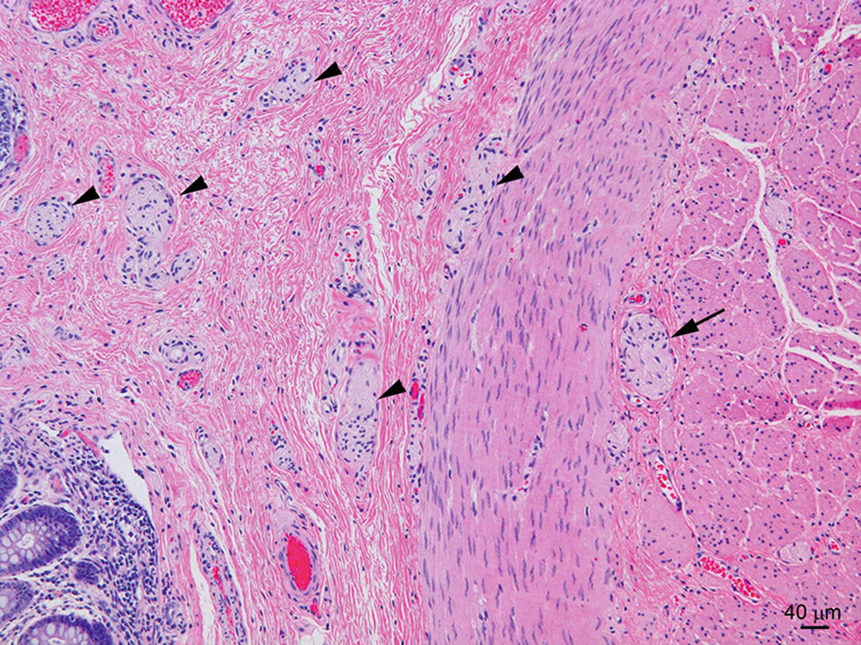 Anatomic Pathology Of Hirschsprung Disease Springerlink