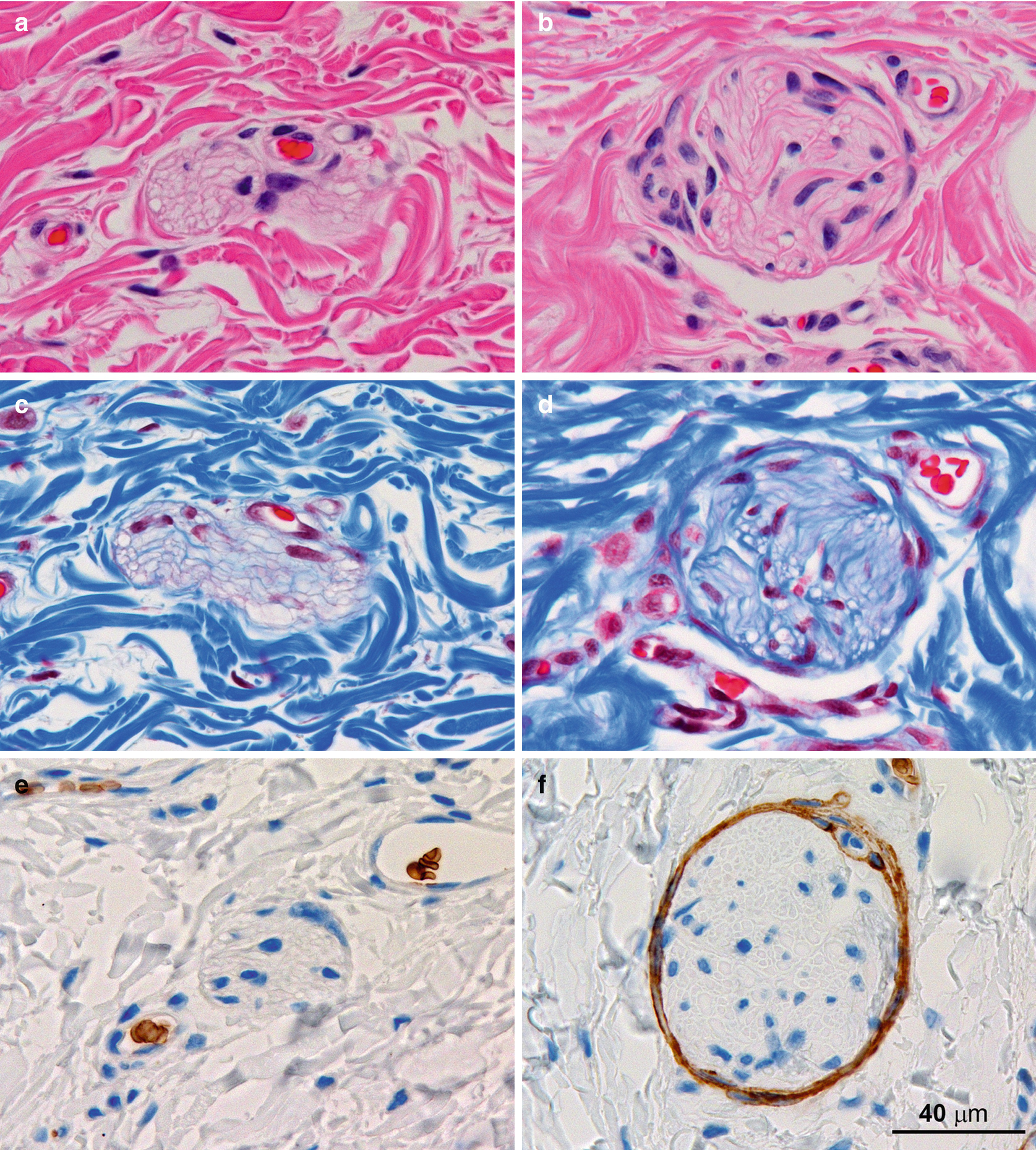 Anatomic Pathology Of Hirschsprung Disease Springerlink