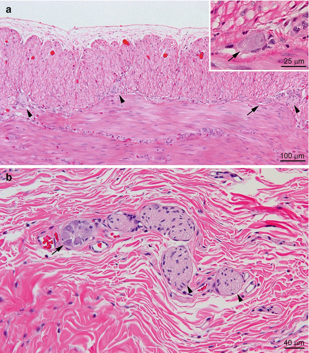 Anatomic Pathology Of Hirschsprung Disease Springerlink