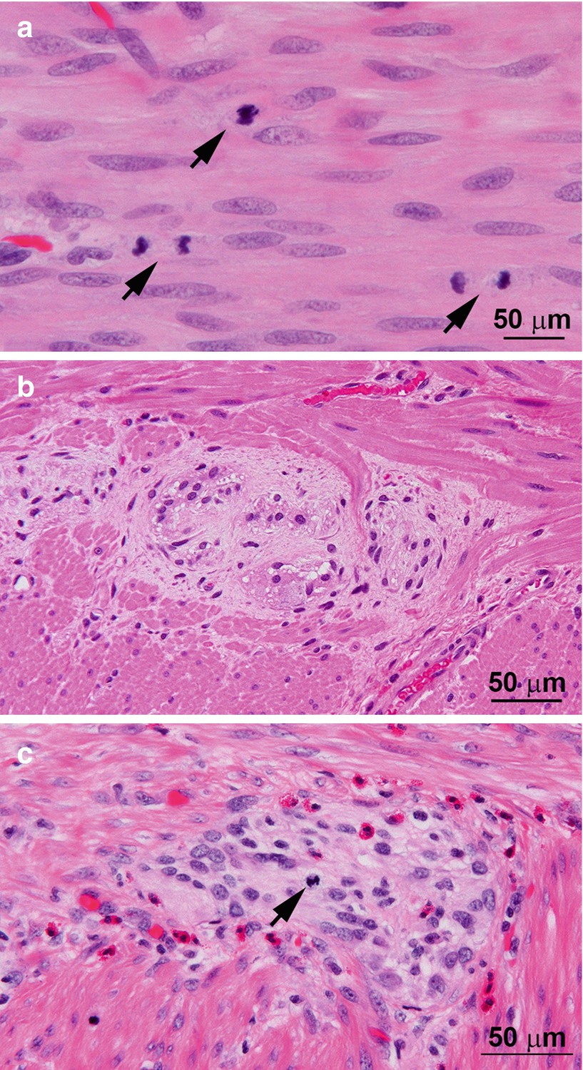 Anatomic Pathology Of Hirschsprung Disease Springerlink