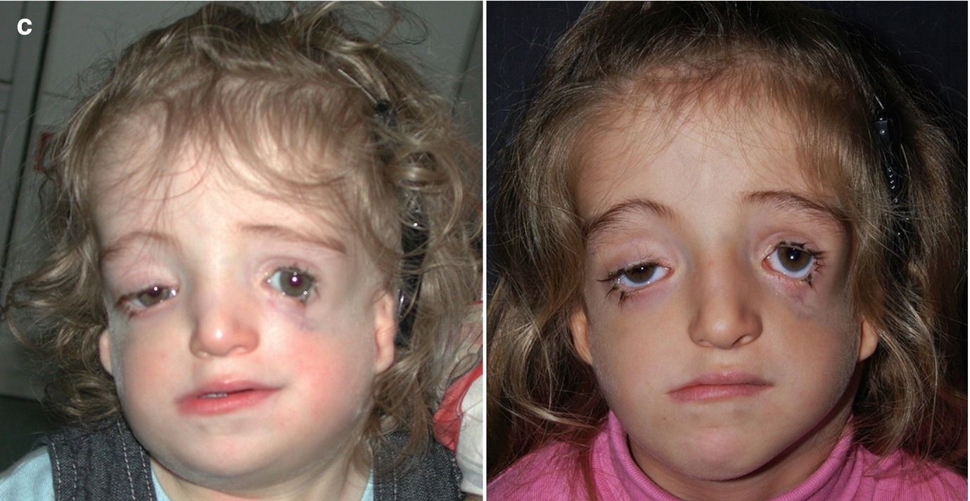 Treacher Collins Franceschetti Syndrome Springerlink