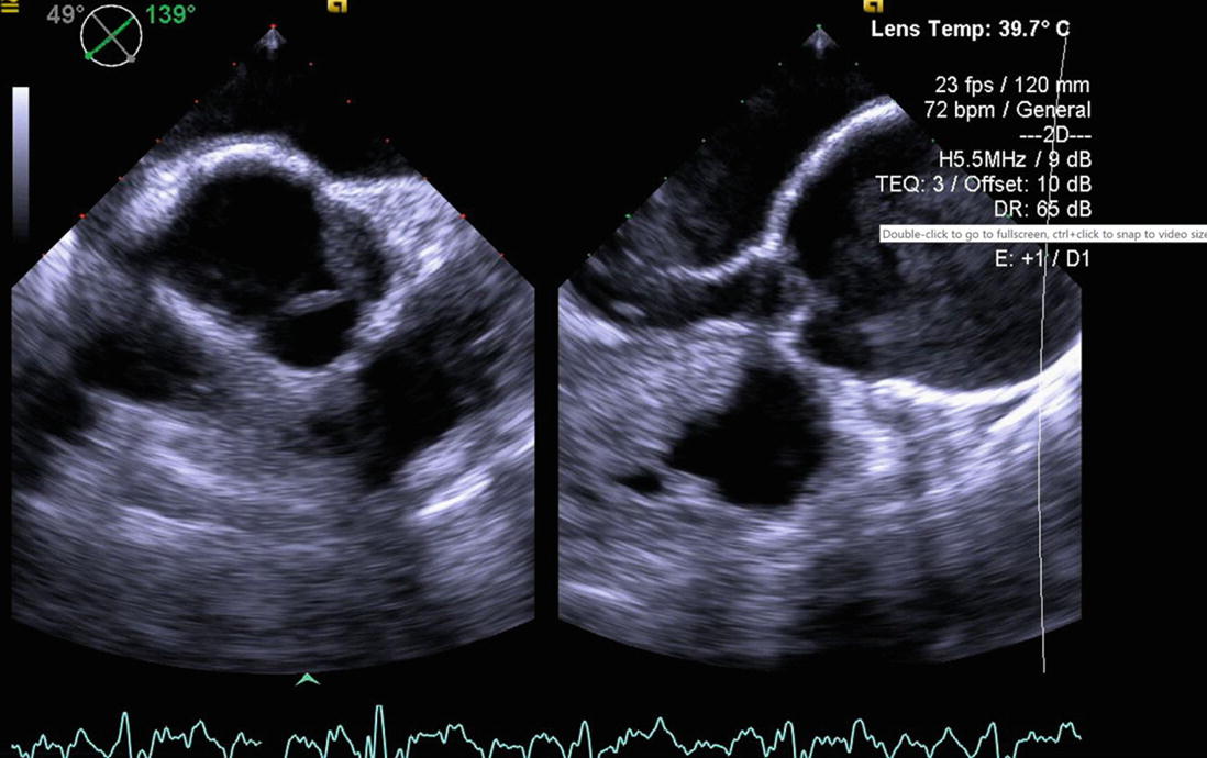 Annulo Aortic Ectasia And Sinus Of Valsalva Aneurysm Springerlink Annulo Aortic Ectasia And Sinus Of Valsalva Aneurysm Springerlink
