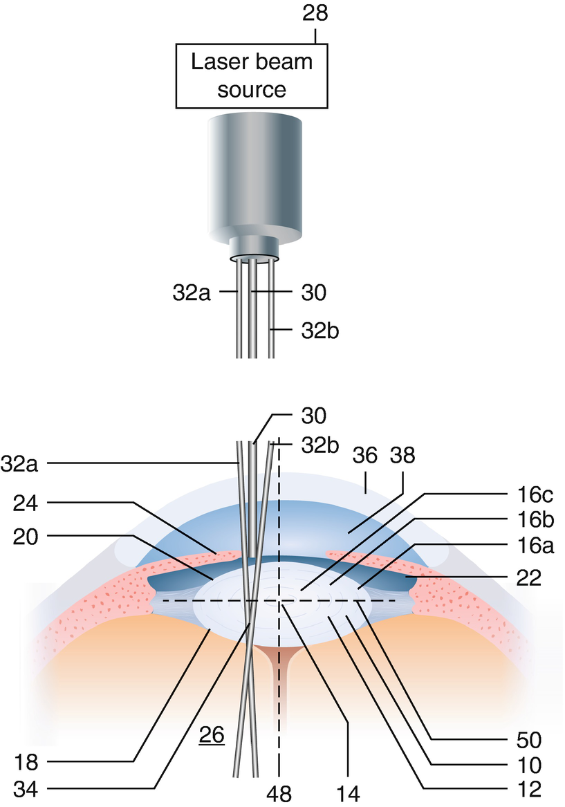 Femtosecond-Laser-Assisted Cataract Surgery (FLACS) | SpringerLink