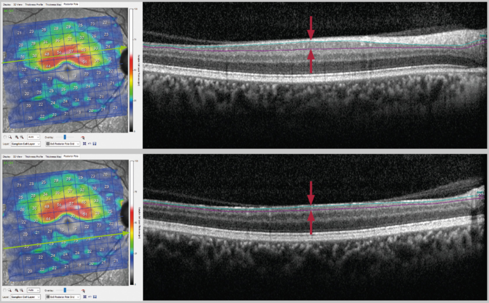 Optical Coherence Tomography (OCT): Principle and Technical ...