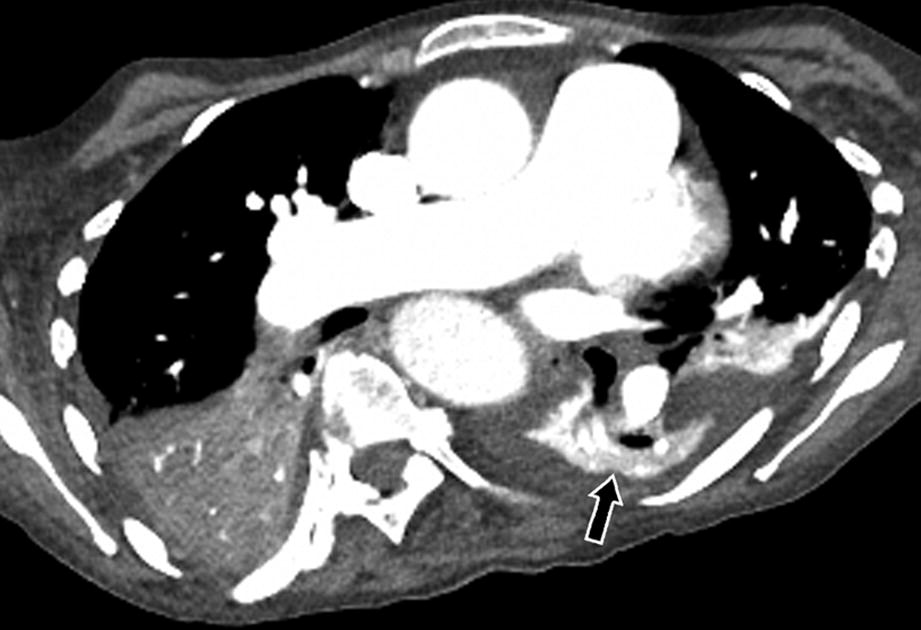 Featured image of post Lobar Collapse Ct