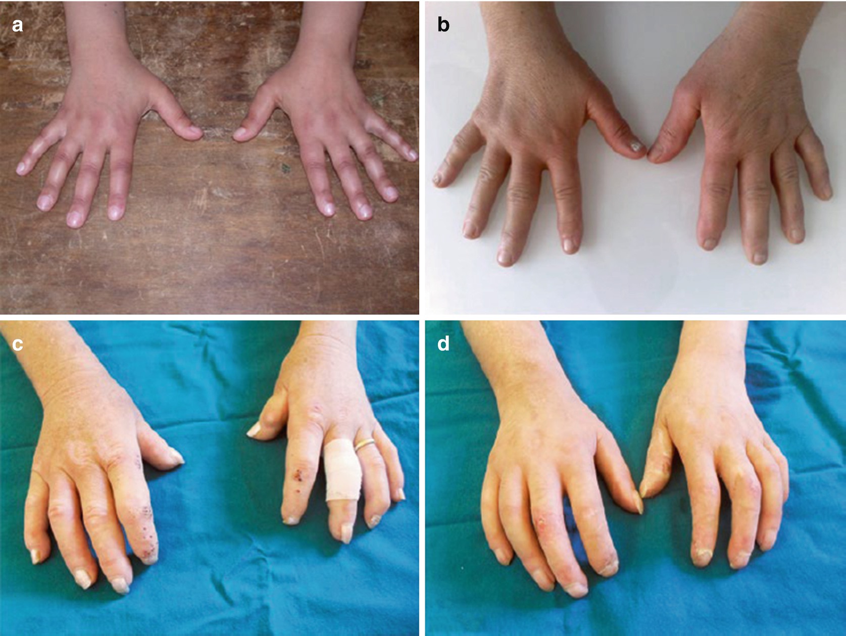 Hand Function In Scleroderma Springerlink