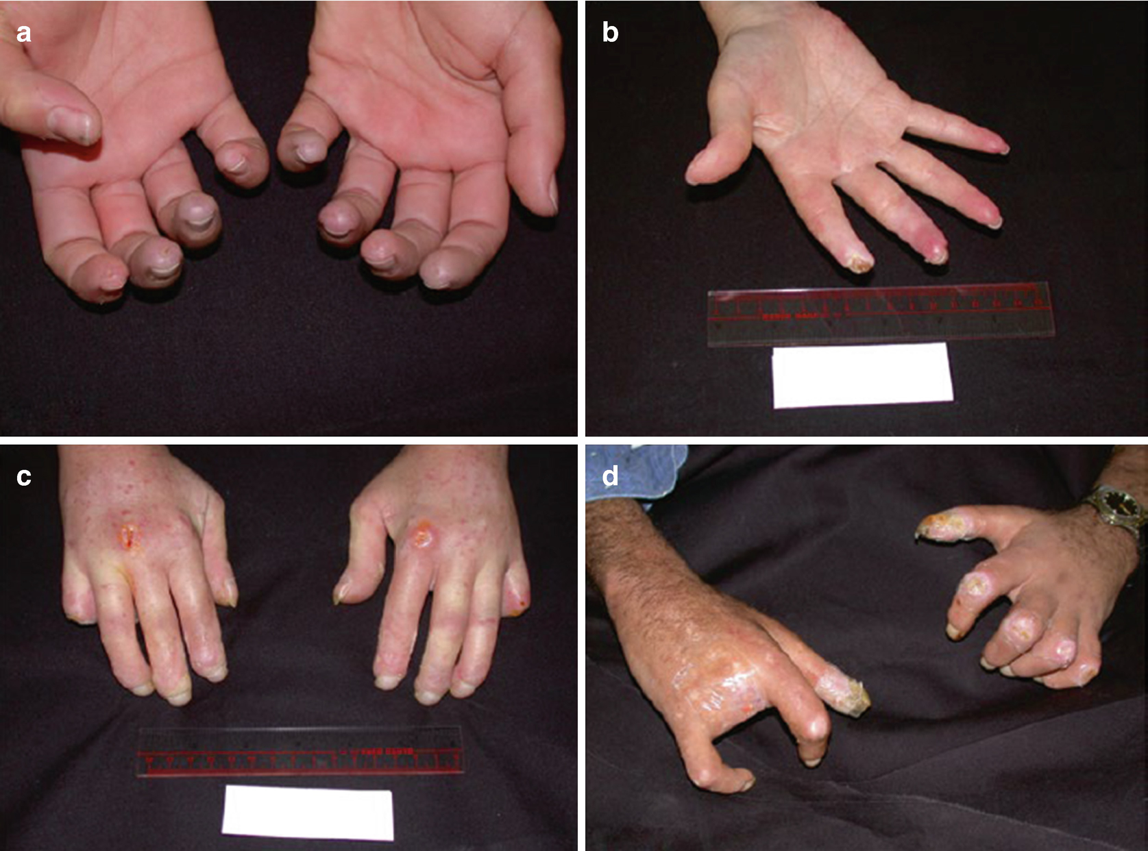 Hand Function In Scleroderma Springerlink