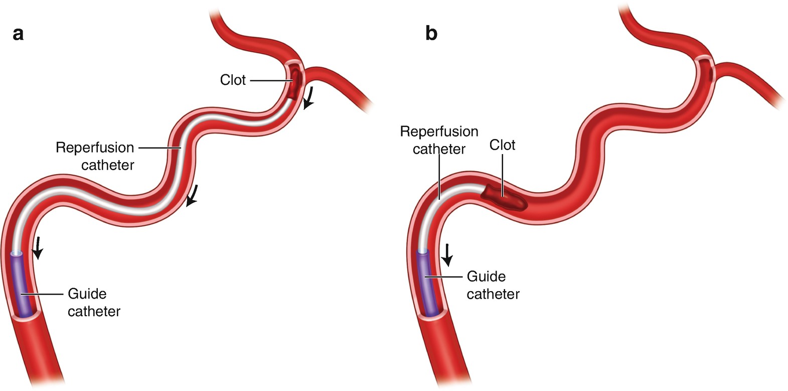 Тромбоз артерии мкб 10. Катетер направленный тромболизис. Реканализация тромба вен. Катетерная фрагментация тромбов.