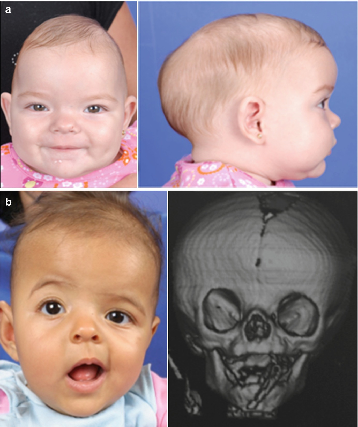 Craniosynostosis Springerlink