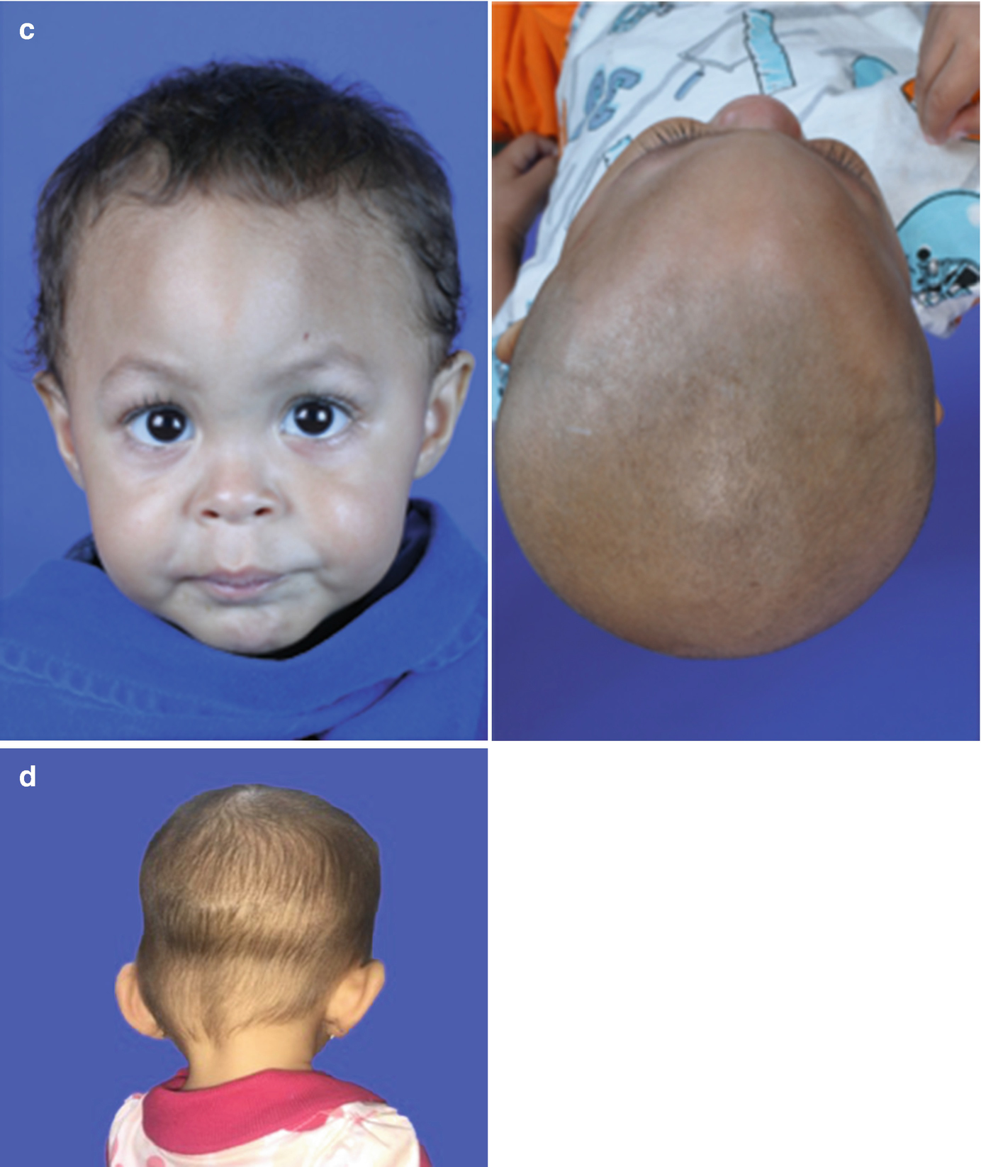 Craniosynostosis Springerlink