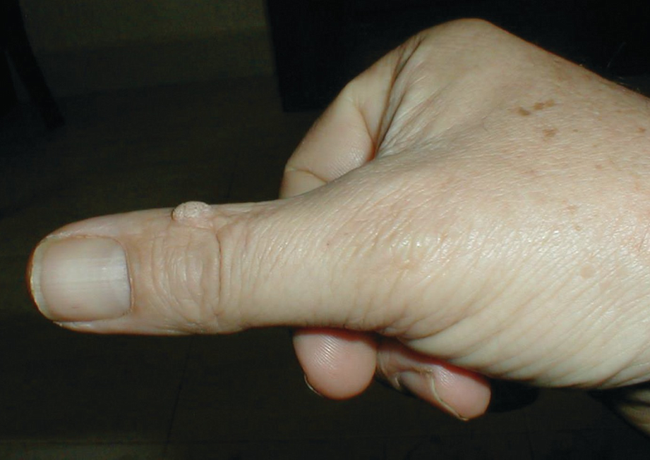 Cutaneous Warts Springerlink