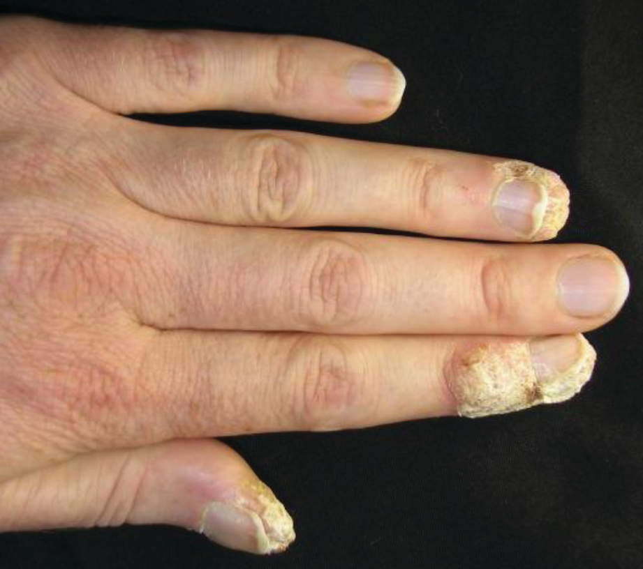 Cutaneous Warts Springerlink Cutaneous Warts Springerlink