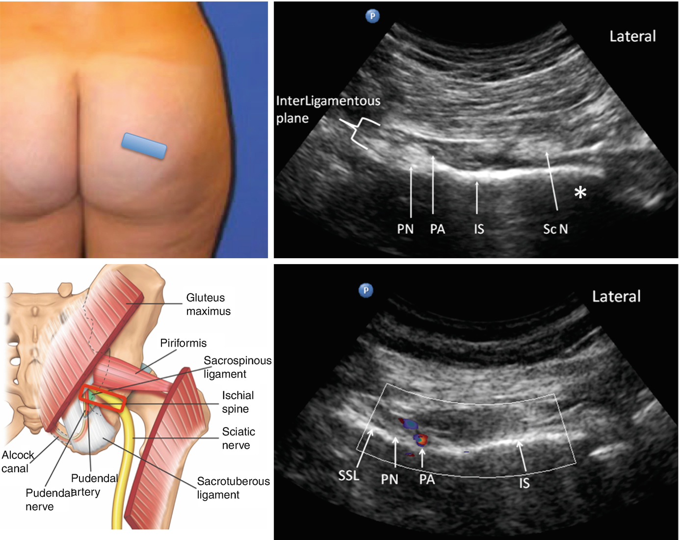 Pudendal And Inferior Cluneal Nerve Springerlink