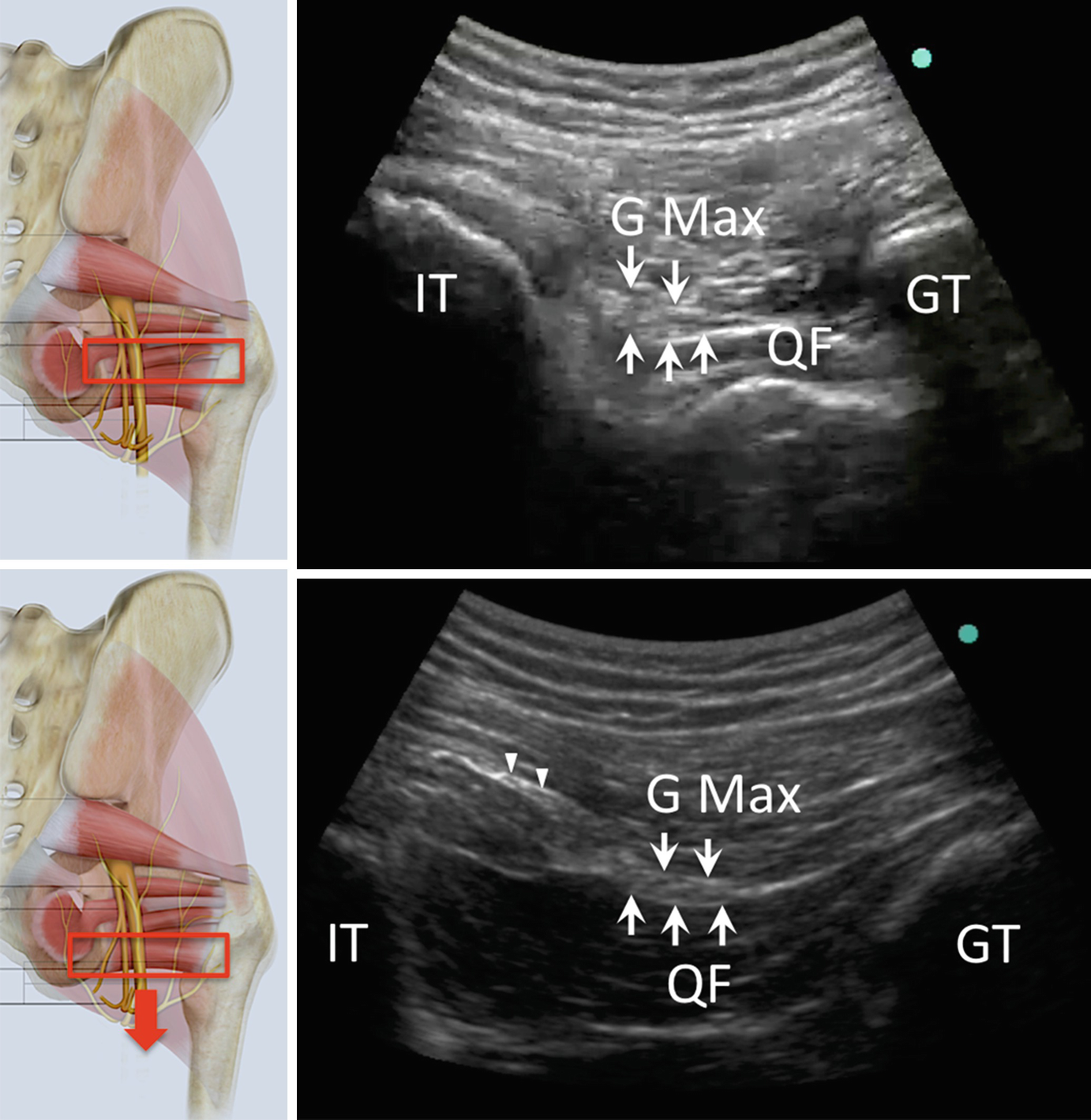Pudendal And Inferior Cluneal Nerve Springerlink