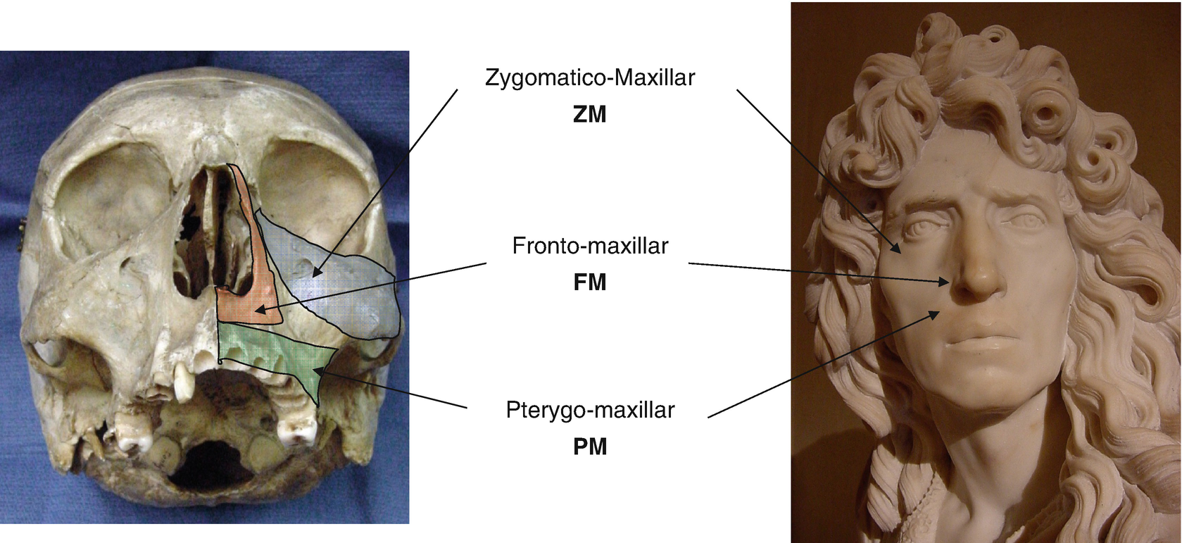 reconstruction of mandible and maxilla after resection for non melanoma skin cancer or cutaneous melanoma springerlink