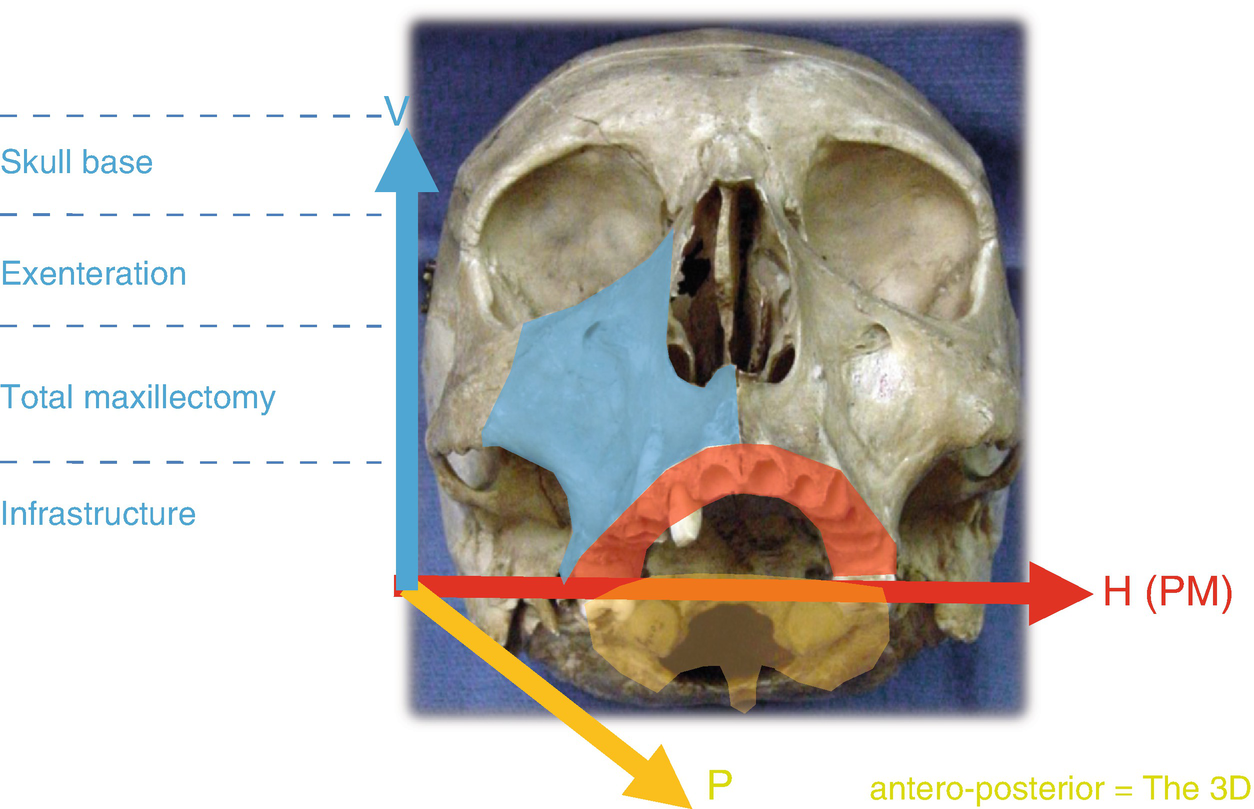 reconstruction of mandible and maxilla after resection for non melanoma skin cancer or cutaneous melanoma springerlink