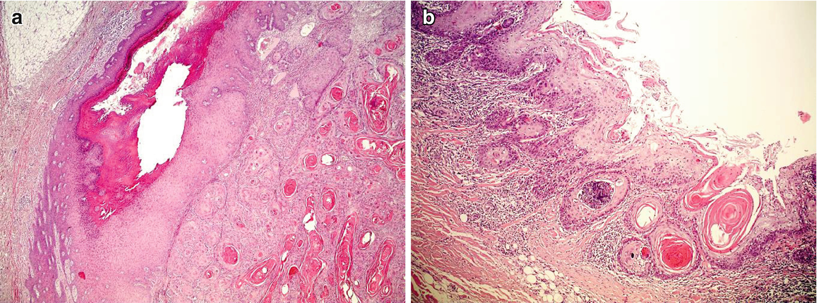 papillomatous epidermal hyperplasia icd 10