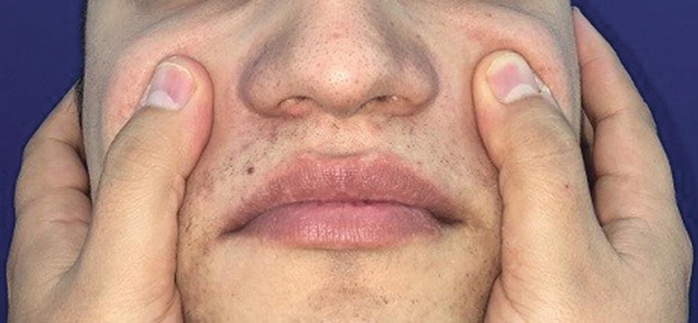 Surgical Management Of The Nasal Septum Springerlink Surgical Management Of The Nasal Septum Springerlink