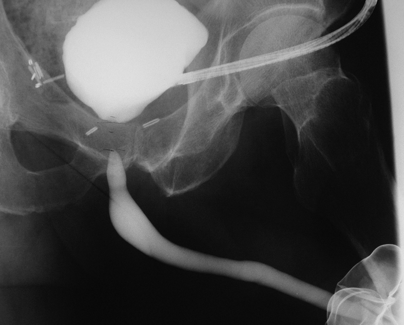 Diagnostic Evaluation of Male Urethral