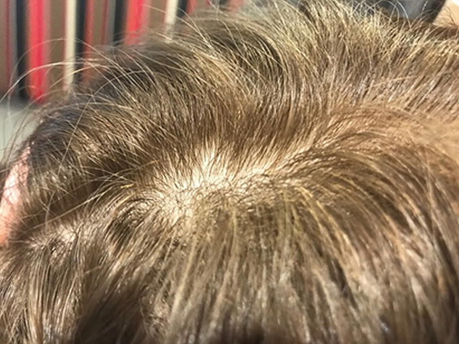 Camouflage Extensions And Electrical Devices To Improve Hair
