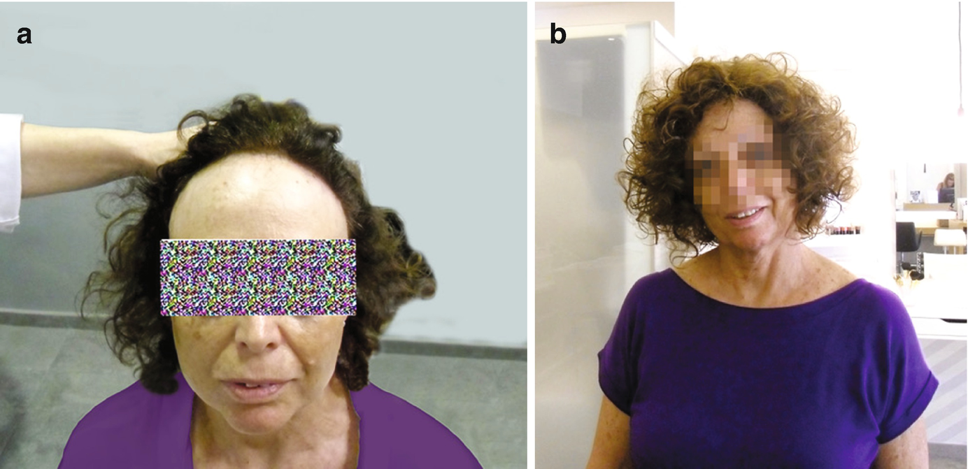Camouflage Extensions And Electrical Devices To Improve Hair Volume Springerlink